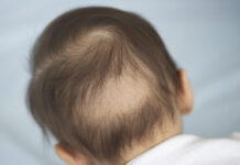 Hair loss of babies