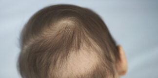Hair loss of babies