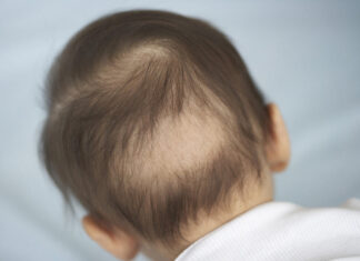 Hair loss of babies