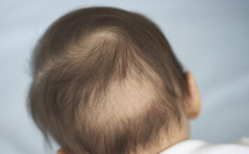 Hair loss of babies